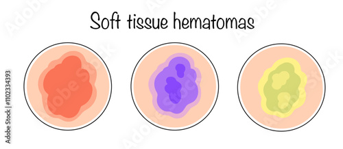 Soft tissue hematomas
