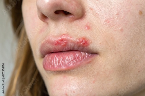 Close-Up of Cold Sore on Lip with Redness and Blister, Dermatology