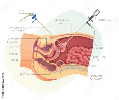 Gynaecological Laparoscopy Key Hole Surgery - Stock Illustration