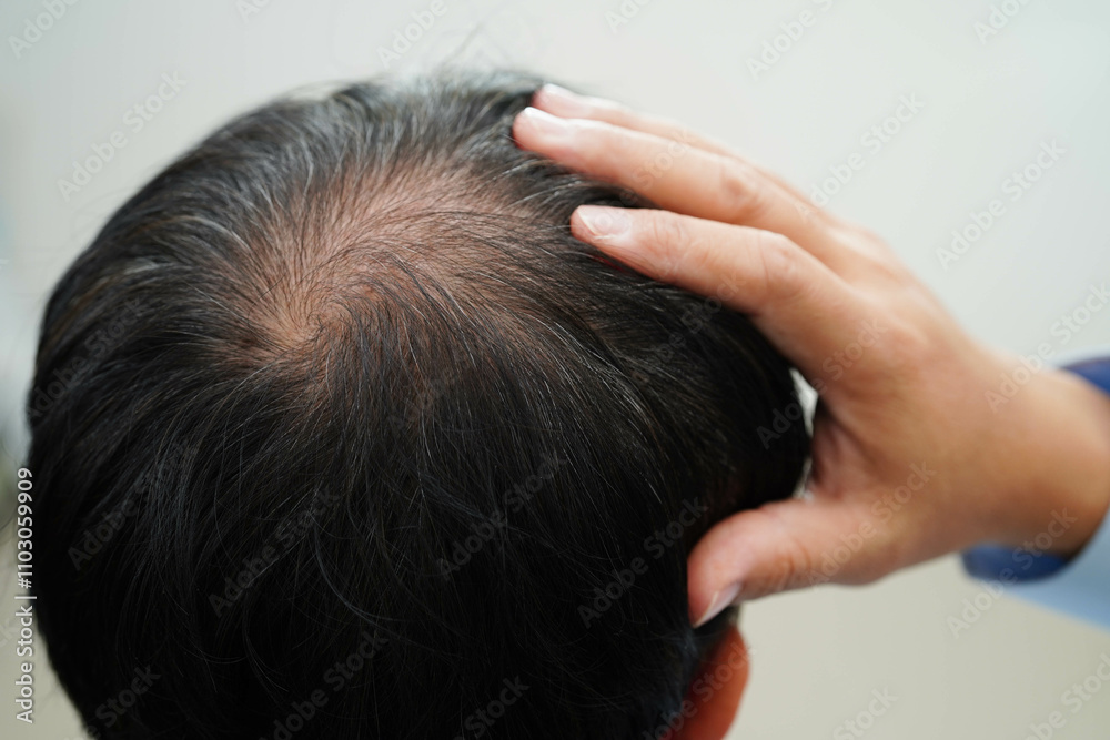 Bald head in man, hair loss treatment health problem. Bald head in man, hair loss treatment health problem.