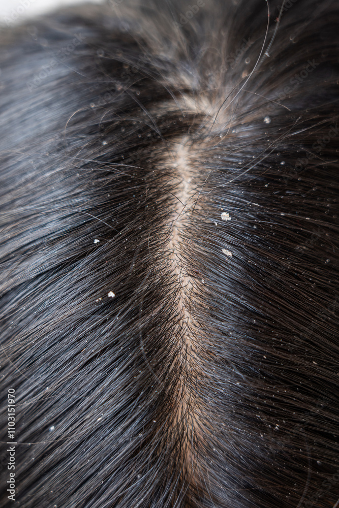 Close up of black hair with dandruff.