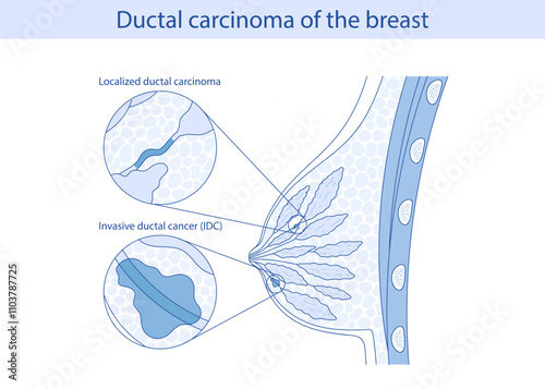 Ductal carcinoma of the breast. DCIS and IDC. Vector illustration in cartoon style.