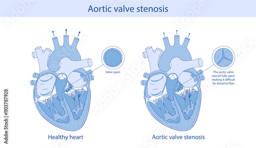 A medical illustration shows the difference between a normal artis valve and a stenotic valve. Illustration in cartoon style