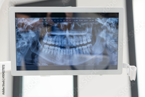 An x-ray image of teeth is shown on a screen in a dental office, helping dentists evaluate a patient's dental health for accurate diagnosis and treatment planning.
