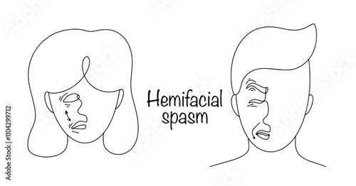 Hemifacial spasm