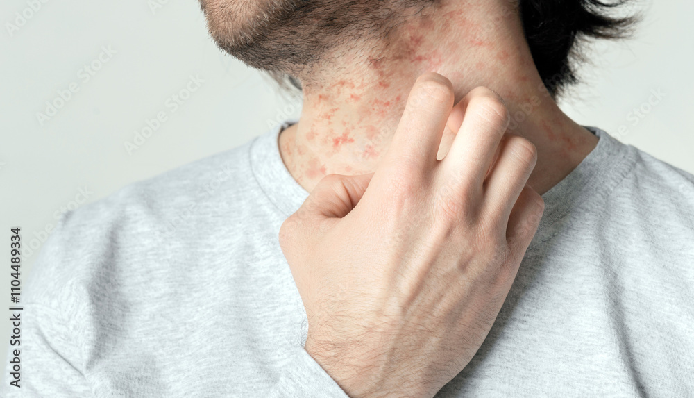 Eczema and itching concept. Red spots on skin of man, empty space, cropped Eczema and itching concept. Red spots on skin of man, empty space, cropped