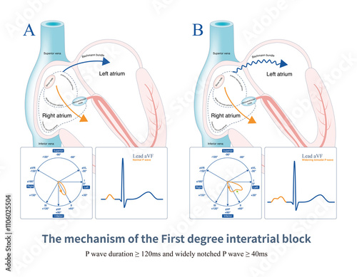 When there is a the first degree interatrial block, the impulse from the right atrium is slowly transmitted to the left atrium, causing widening notched  P wave. photo