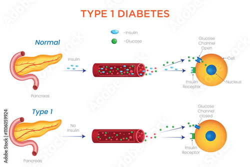 Type 1 Diabetes Understanding Causes, Symptoms, and Insulin Management