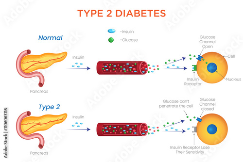 Type 2 Diabetes Causes, Symptoms, and Management Strategies photo