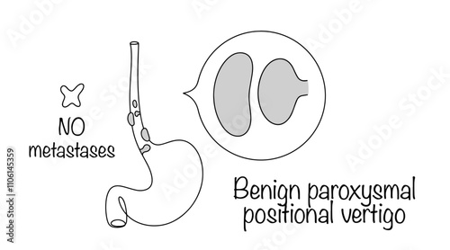 Benign Esophageal Tumors