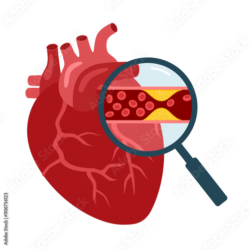 Cholesterol in human blood vessels and heart. Fat cells in vein arteries. Blocked vascular and plaque in artery. Medical poster for clinic or lab in flat design vector illustration.