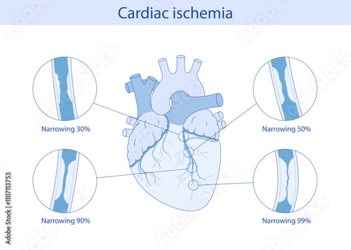 cardiac ischemia. anatomical illustration drawn in cartoon style