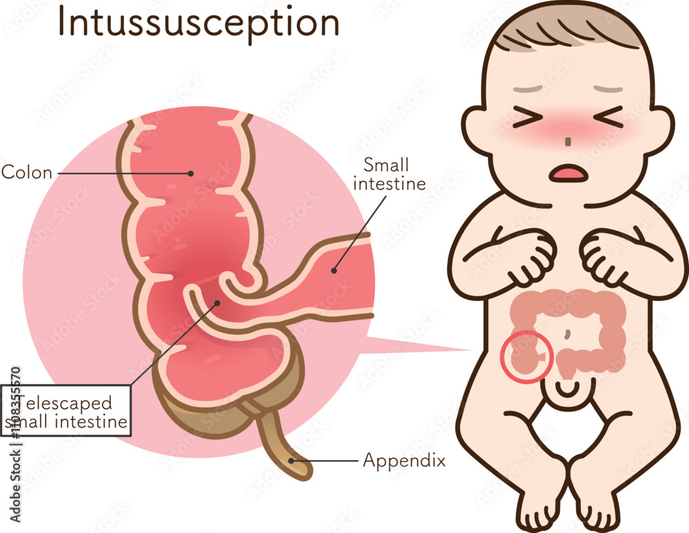 Fototapeta premium 腸重積症、Intussusception、イラスト