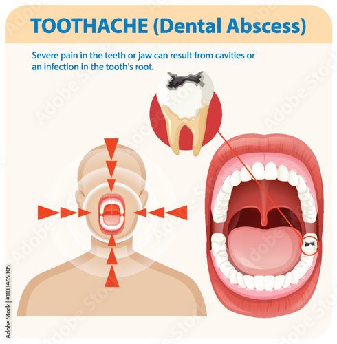 Understanding Toothache and Dental Abscess