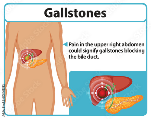 Understanding Gallstones and Symptoms
