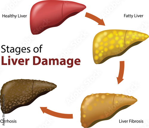 illustration of liver damage stages