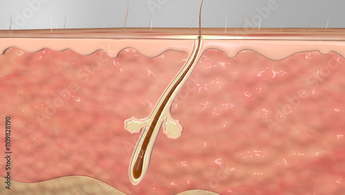 Hair Folicle Sebacious Gland Infected Pimple