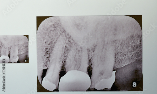 Tableau sur toile Periapical x-ray for upper 5,6 and 7 showing class II restoration in the 5 and 7