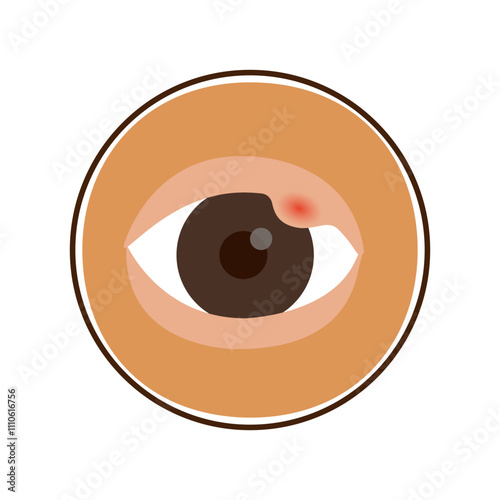 hordeolum eyes infection and abscess disease