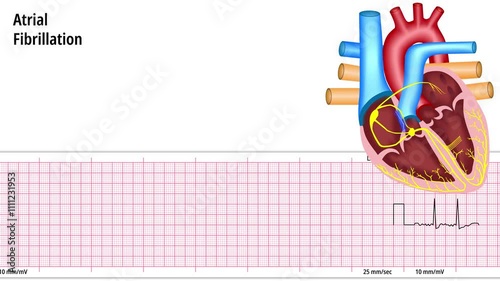 Atrial Fibrillation - ECG and Heart Conduction - Electrocardiogram Medical Animation photo