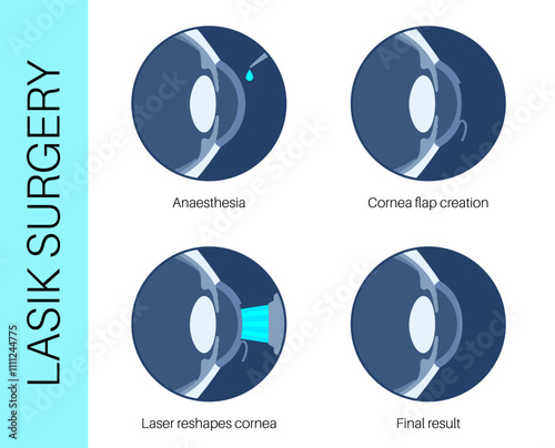 LASIK eye surgery