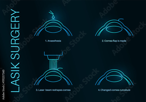 LASIK eye surgery