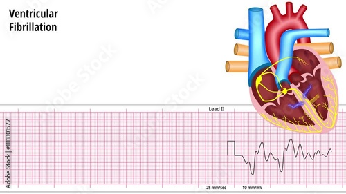 Ventricular Fibrillation - ECG and Heart Conduction - Electrocardiogram Medical Animation photo