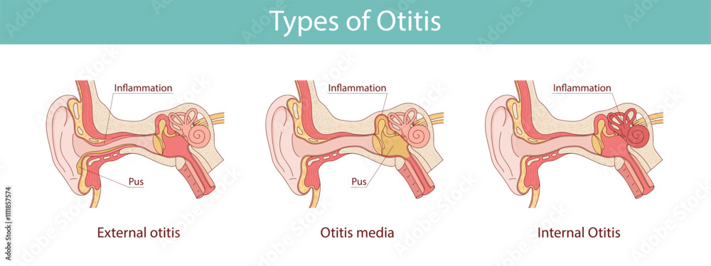 Obraz na plátně human ear inflammation