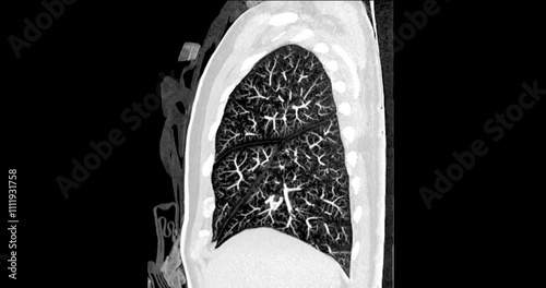 CT Chest Sagittal view Normal Study: CT chest footage reveals normal lung, heart, and mediastinal structures, showing no signs of abnormalities, ensuring a healthy thoracic region.