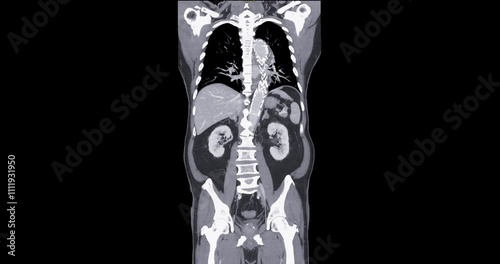 CTA Whole Aorta with Stent-Grafts Coronal view: CTA scan of the whole aorta, highlighting thoracic aorta endovascular stent-grafts placed for aneurysm repair and blood flow restoration.
