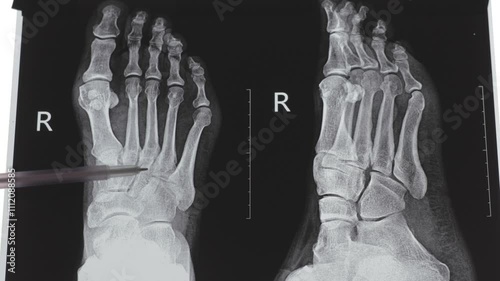 Doctor learning X-ray of foot fingers. Radiography foot bones. Metatarsal, Tarsals, Phalanges bone. Treatment of Sprains and dislocations of the muscles and bones of the foot. 4k footage.