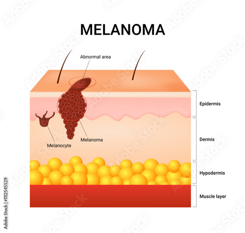 Causes of Melanoma Skin Cancer Disease