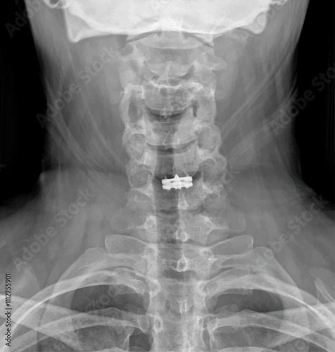 Neck X-ray of a patient undergoing Cervical Microdiscectomy and Cervical Disc Prosthesis for Medical Research and Teaching. Vector illustration. 
