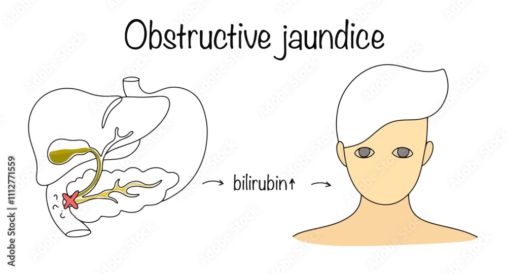 Fototapeta premium Obstructive jaundice