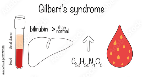 Gilbert's syndrome