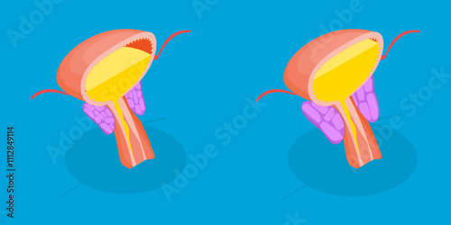 3D Isometric Flat Vector Illustration of Enlarged Prostate Gland, Benign Prostatic Hyperplasia photo
