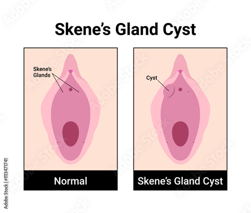 Skene's Gland Cyst Medical Vector Illustration