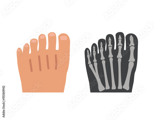 Human polydactyly. 6 toe external and internal view on x-ray. Medical chart.