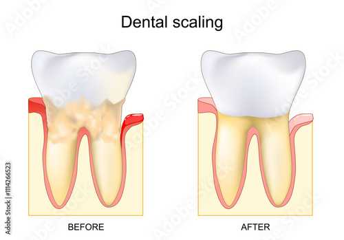 Dental calculus. Professional cleaning or scaling. removing tartar