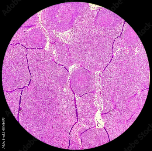 Photomicrograph of Pelvic node histology showing Free of Metastasis, means that cancer has not spread from its original location to other parts of the body. photo