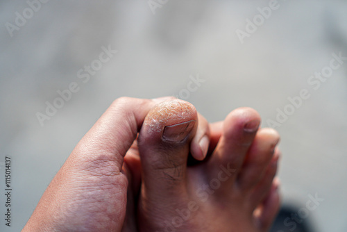 A detailed close-up of a foot exhibiting signs of dry, cracked skin and a potential fungal infection on the toe. Close-up Image of a Foot with Dry, Cracked Skin and Fungal Infection on the Toe.