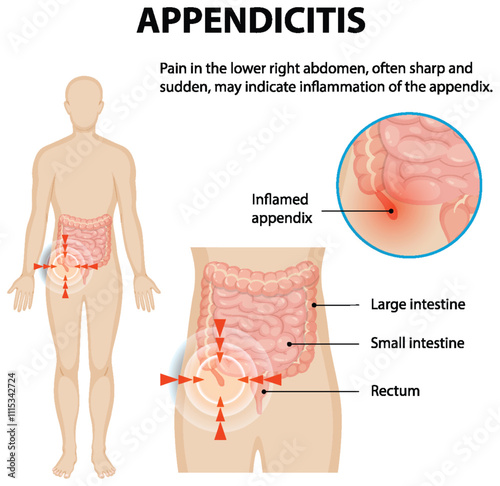 Understanding Appendicitis and Abdominal Pain