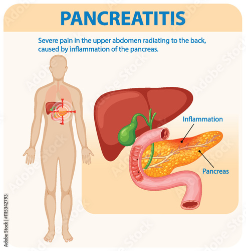 Understanding Pancreatitis and Its Symptoms