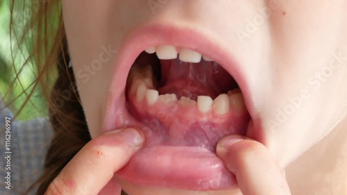 The little girl's mouth lowers her lower lip with her fingers, showing her teeth. 2 baby teeth have fallen out, permanent ones are growing.