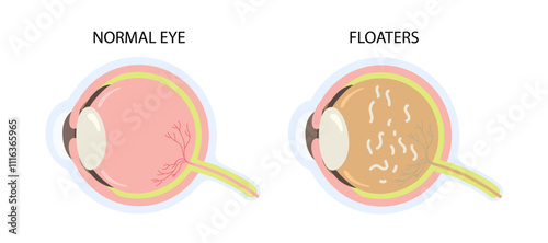 Cross section of eye with floaters vector illustration. Particles show shadows problem vision concept