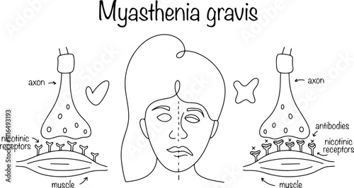 Myasthenia gravis