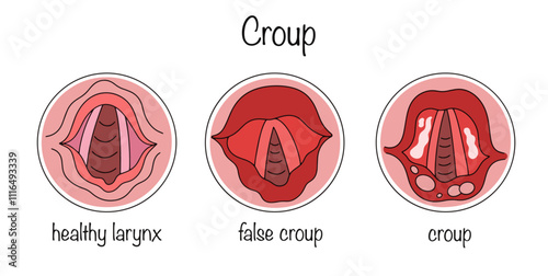 Croup
