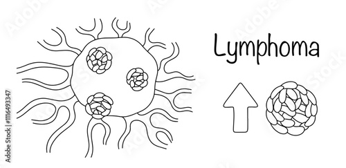 Lymphoma
