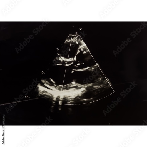 Left ventricular systolic dysfunction(LVSD). Aortic sclerosis.