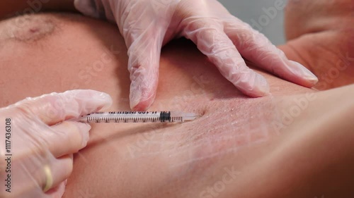 Medical professional wearing latex gloves performing injection with a syringe into a patient skin of armpit, showcasing vital healthcare practices within a clinical environment. hyperhidrosis
